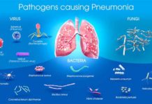 Cari Tahu Yuk Pencegahan dan Pengobatan dari Pneumonia